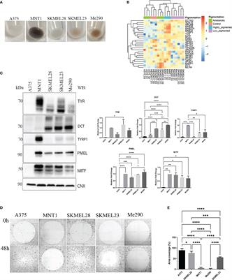 New panel of biomarkers to discriminate between amelanotic and melanotic metastatic melanoma